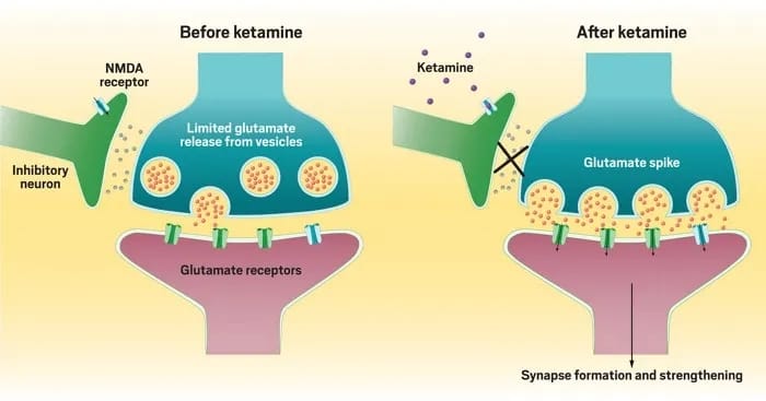 Diagram comparing synaptic activity before and after ketamine therapy: before, NMDA receptor inhibits glutamate release; after ketamine therapy blocks this, causing a glutamate spike and enhanced synapse formation and strengthening.